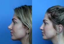 عمل سرپایی ترمیم بینی