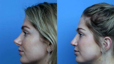 عمل سرپایی ترمیم بینی