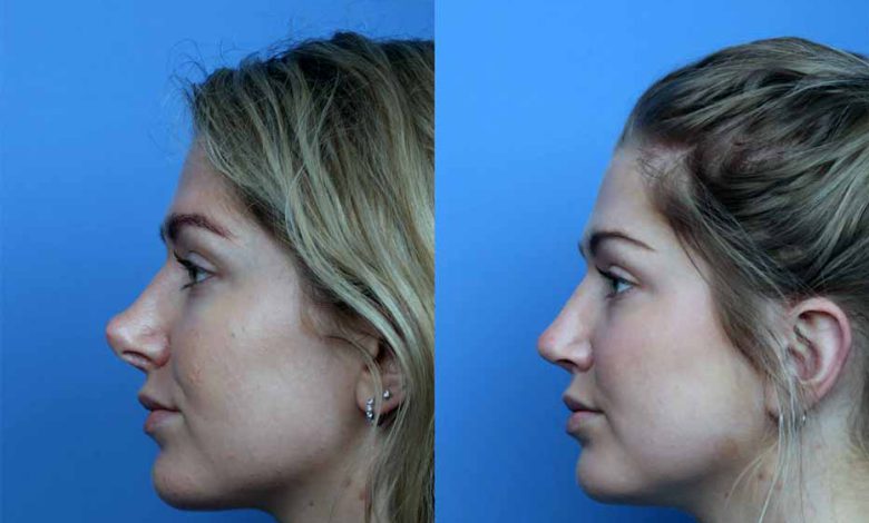 عمل سرپایی ترمیم بینی