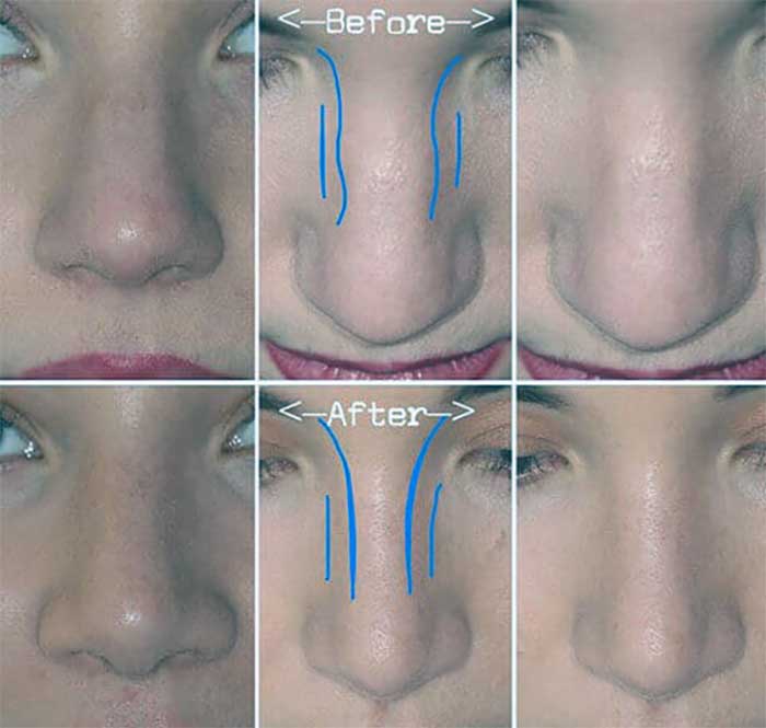 جراحی ترمیمی بینی