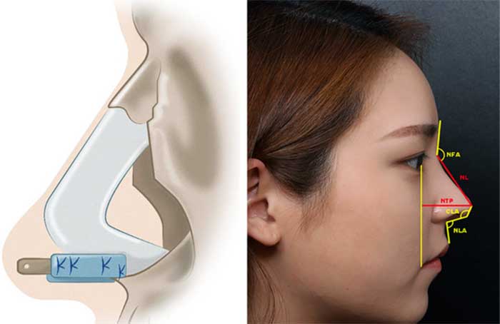 جراحی ترمیمی بینی