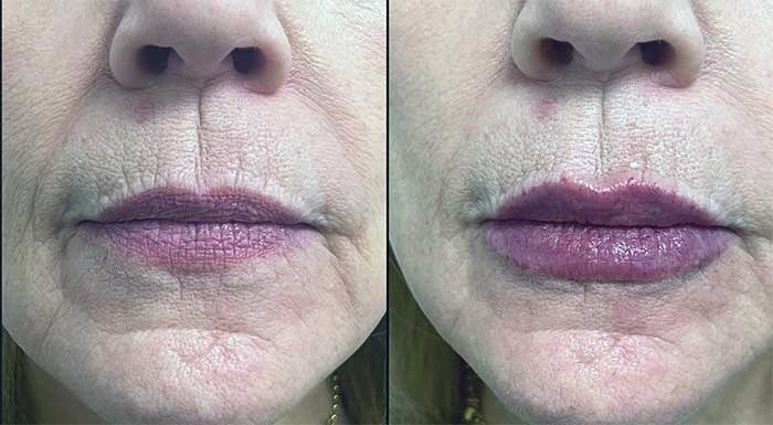 فیلرهای پوستی