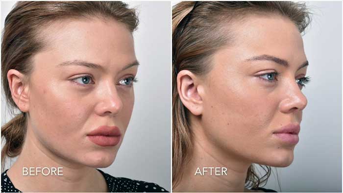 لیفت صورت با نخ