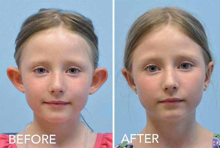 جراحی زیبایی گوش