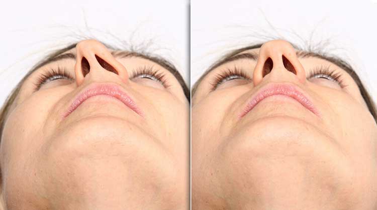 انحراف سپتوم