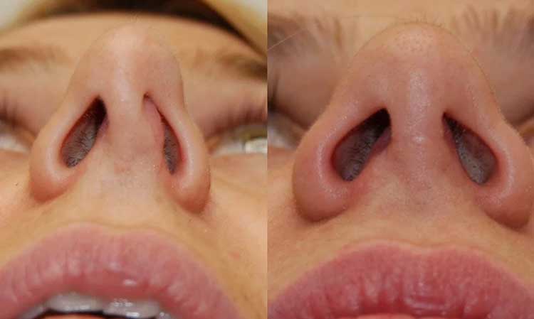 سپتوپلاستی