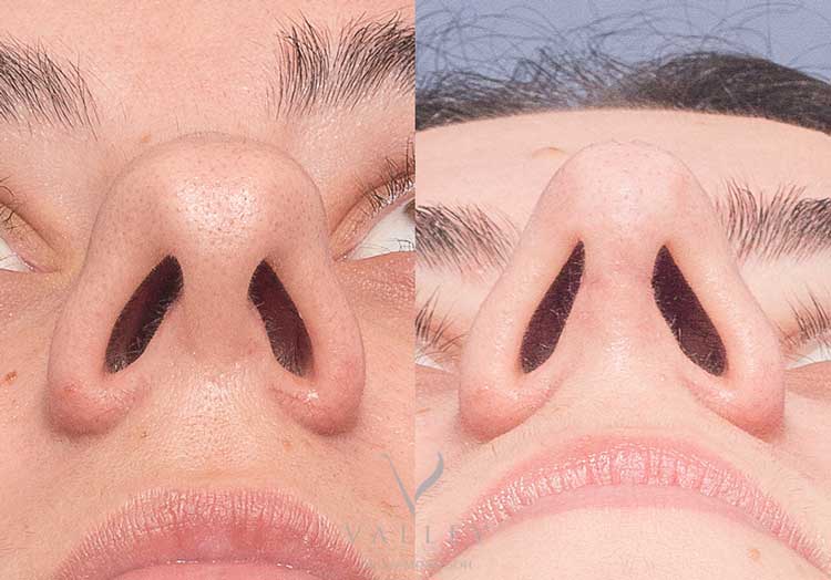 عمل ترمیم تیغه بینی