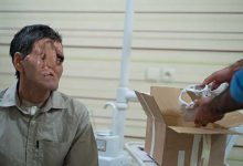 بزرگترین عمل جراحی تغییر چهره در ایران با عکس